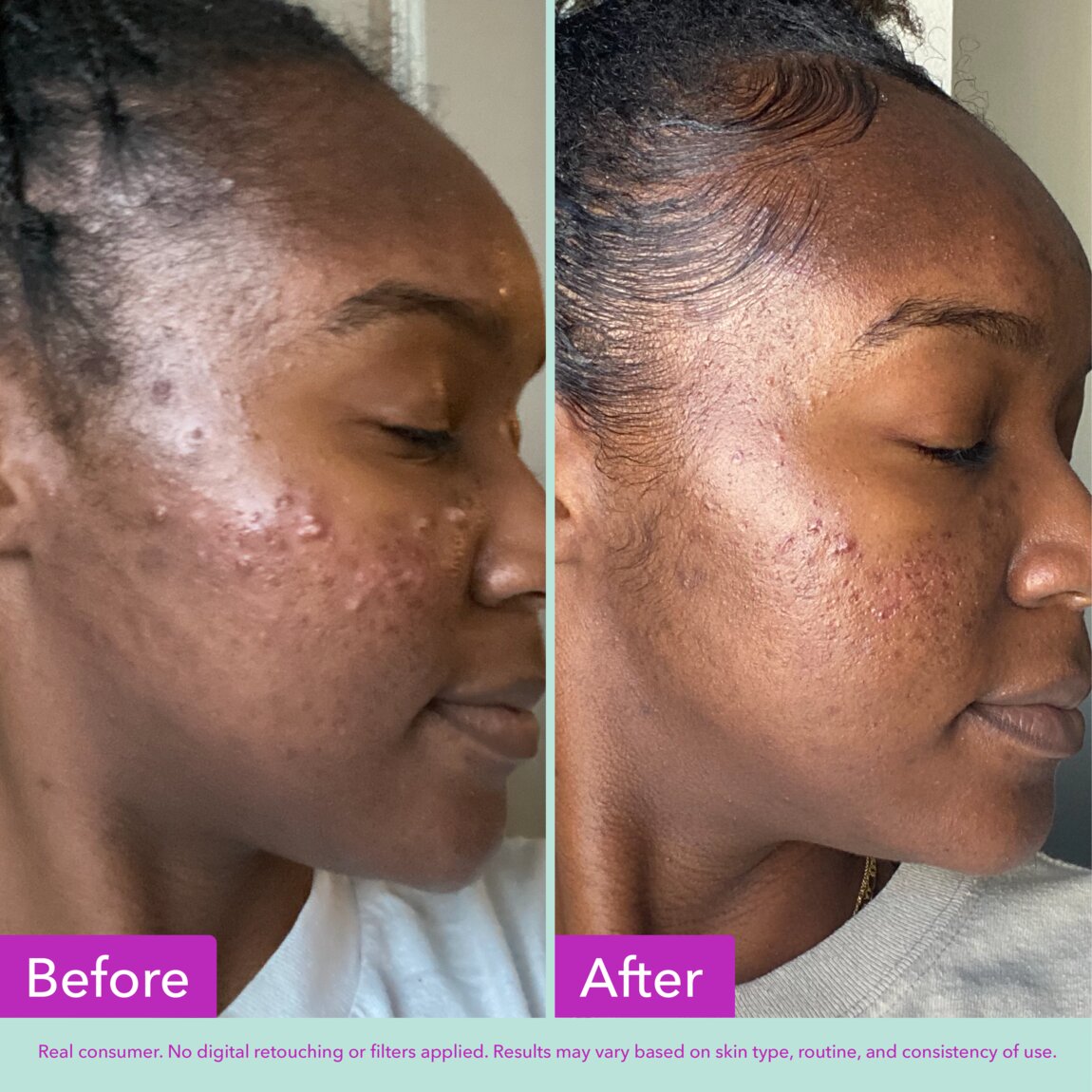 acne-foaming-cleanser-u2 zb_p.jpg
